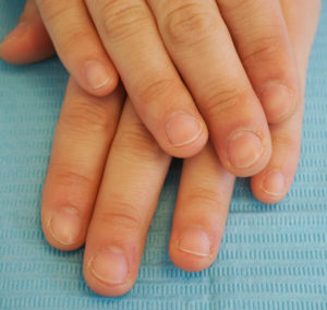 深爪　噛み爪　軽度　中度　改善　矯正　施術　ネイル　サロン