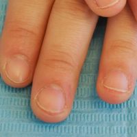 深爪　噛み爪　軽度　中度　改善　矯正　施術　ネイル　サロン