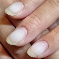 深爪　噛み爪　軽度　中度　改善　矯正　施術　ネイル　サロン 改善　コンプレックス　治る　ボロボロ