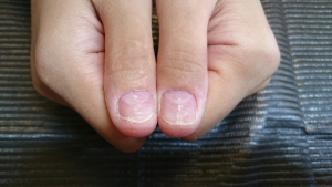 深爪　噛み爪　軽度　中度　改善　矯正　施術　ネイル　サロン 改善　コンプレックス　治る　ボロボロ