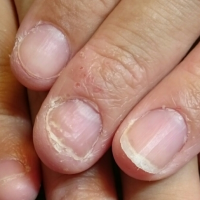 深爪　噛み爪　軽度　中度　改善　矯正　施術　ネイル　サロン 改善　コンプレックス　治る　ボロボロ