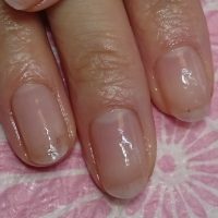 深爪　噛み爪　軽度　中度　改善　矯正　施術　ネイル　サロン 改善　コンプレックス　治る　ボロボロ