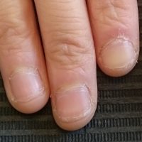 深爪　噛み爪　軽度　中度　改善　矯正　施術　ネイル　サロン 改善　コンプレックス　治る　ボロボロ