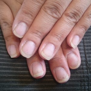 深爪　噛み爪　軽度　中度　改善　矯正　施術　ネイル　サロン 改善　コンプレックス　治る　ボロボロ